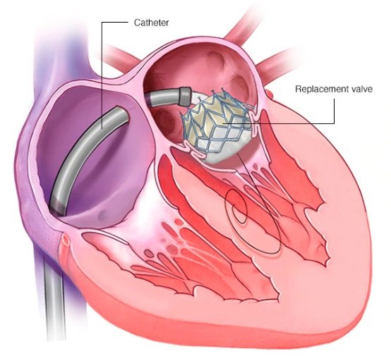 Syria 1st Heart Surgery Mitral Valve Replacement in the